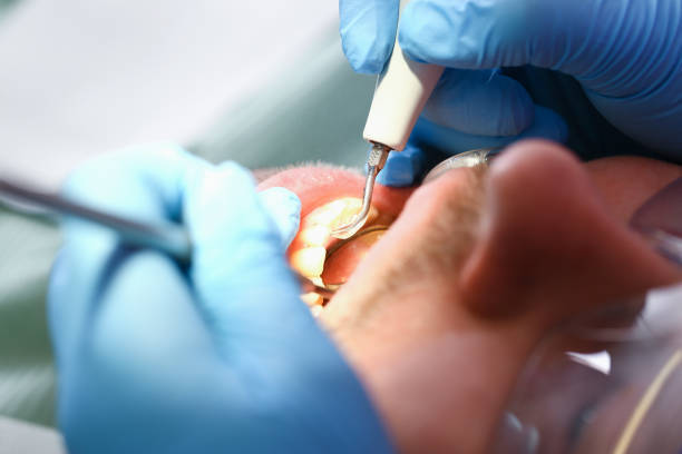 Best Emergency Dentist for Lost Fillings or Crowns in Forest Glen, MD